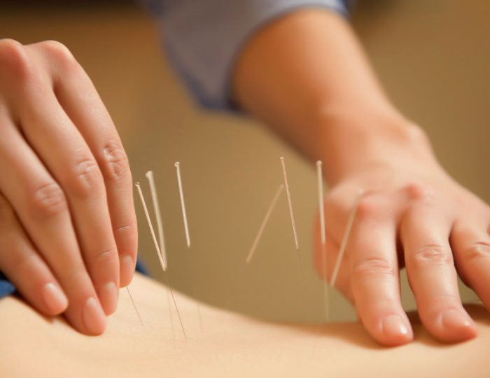 Иглорефлексотерапия - Санаторий «Боровое»